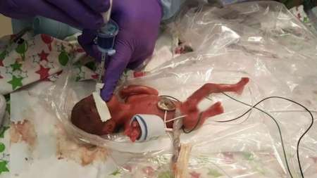 Nació la beba más pequeña del mundo: pesó 245 gramos tras 23 semanas de gestación