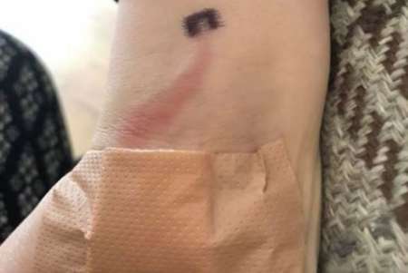 Vio que su hijo tenía una extraña marca roja en su brazo y, sin saber, le salvó la vida