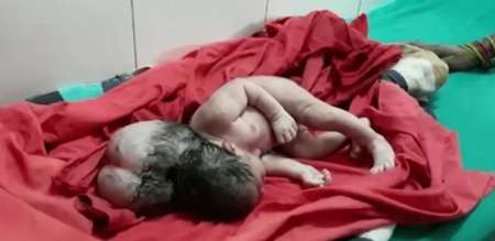 El nacimiento de una beba con "tres cabezas" causa conmoción mundial