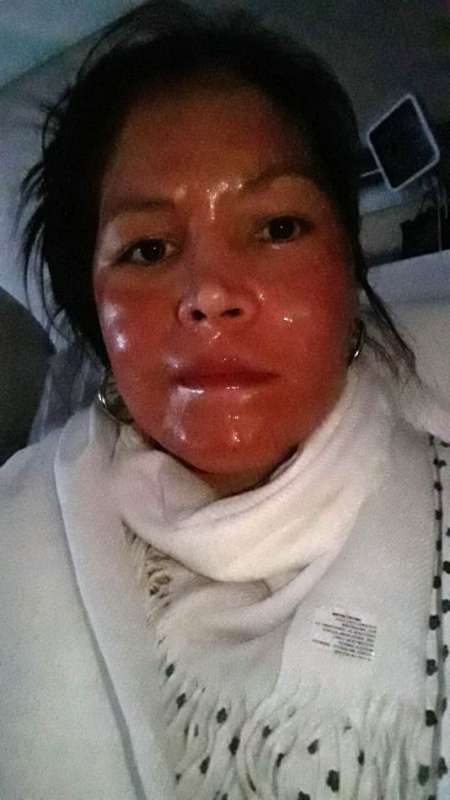 Fue a hacerse un peeling químico y le quemaron la cara