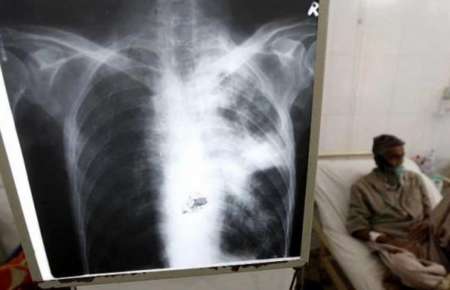 Por año, 800 salteños contraen tuberculosis en Salta: una nena murió