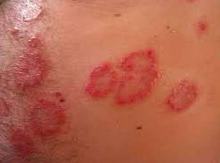 Advierten que aumentaron los casos de sífilis y VIH en Salta