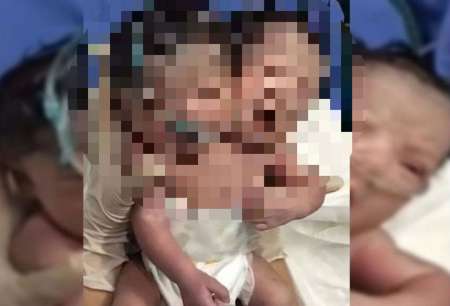 Una bebé nació con dos cabezas y su mamá acusó al médico por mala práxis