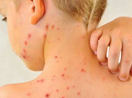 Alerta: primera muerte por sarampión en Argentina luego de 22 años