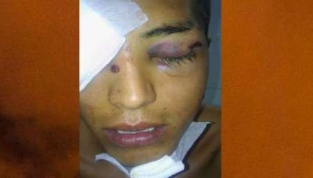 Perdió un ojo y podría quedar ciego tras un abuso policial