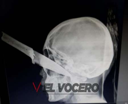 Máxima crueldad: la joven atacada con un cuchillo lucha por su vida