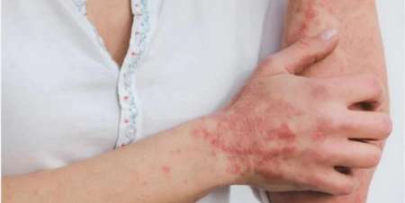 Confirmaron el primer caso de viruela del mono en Argentina