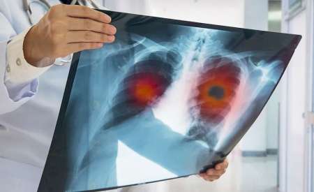 Preocupan la cantidad de casos de tuberculosis en Salta