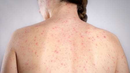 Se detectó un caso probable de sarampión en Salta