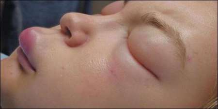 Angioedema Hereditario. Foto de periodistadigital.com