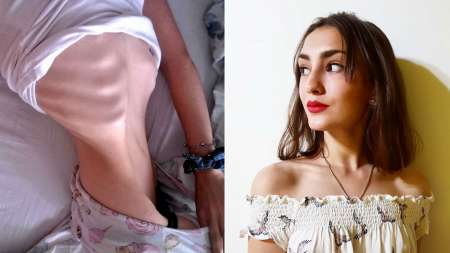 Mostró el impacto de la anorexia en su cuerpo y la foto se volvió viral: “Decidí vivir”