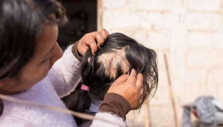Una vecina cercana al vertedero muestra la cabeza de su hija que hace cinco años sufrió problemas en el cuero cabelludo. Jan Touzeau