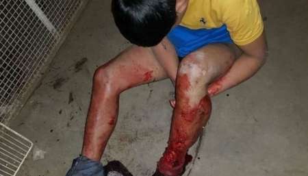 Saltó una reja para robar la casa de una anciana y lo atacó un pitbull: sufrió graves heridas