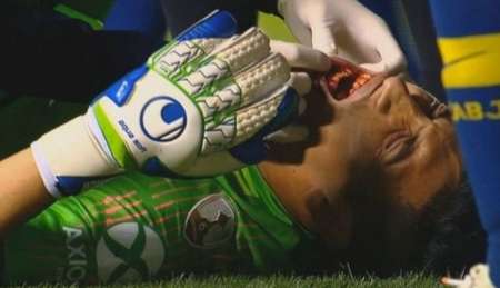 El arquero Esteban Andrada sufrió una fractura de mandíbula y se perderá el resto de la Libertadores