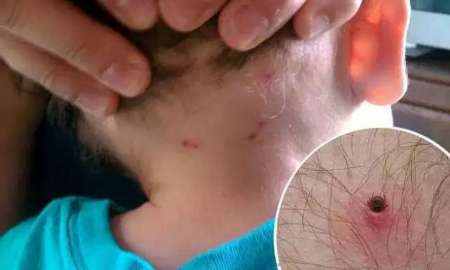 Garrapata mortal ataca otra vez, ahora a un niño de un año en El Galpón