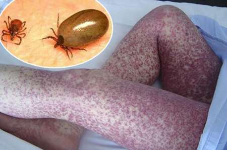 Ojo con las garrapatas: piden prevenir una infección que ya contrajeron dos salteños